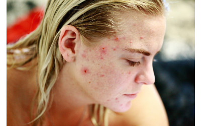 Acne Clear Skin Course